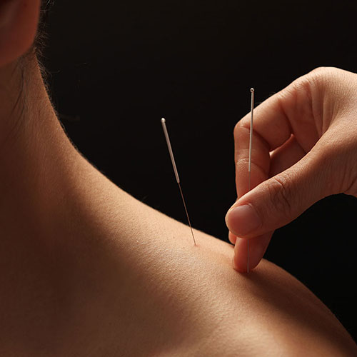 sports akupunktur og sports-massage i Slagelse